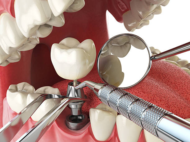 Best Emergency Dentist for Lost Fillings or Crowns in Thedral City, CA